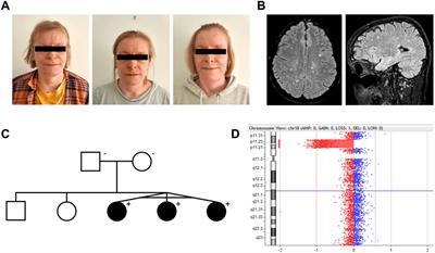 Monozygotic triplets with juvenile-onset autoimmunity and 18p microdeletion involving PTPRM